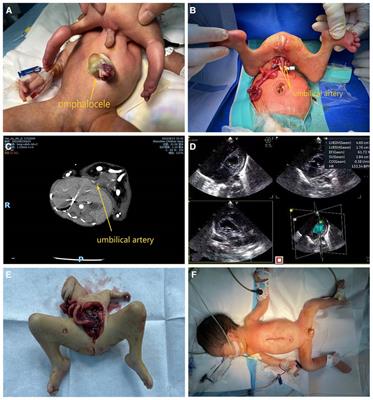 Case report: Epigastric heteropagus twins and literature review